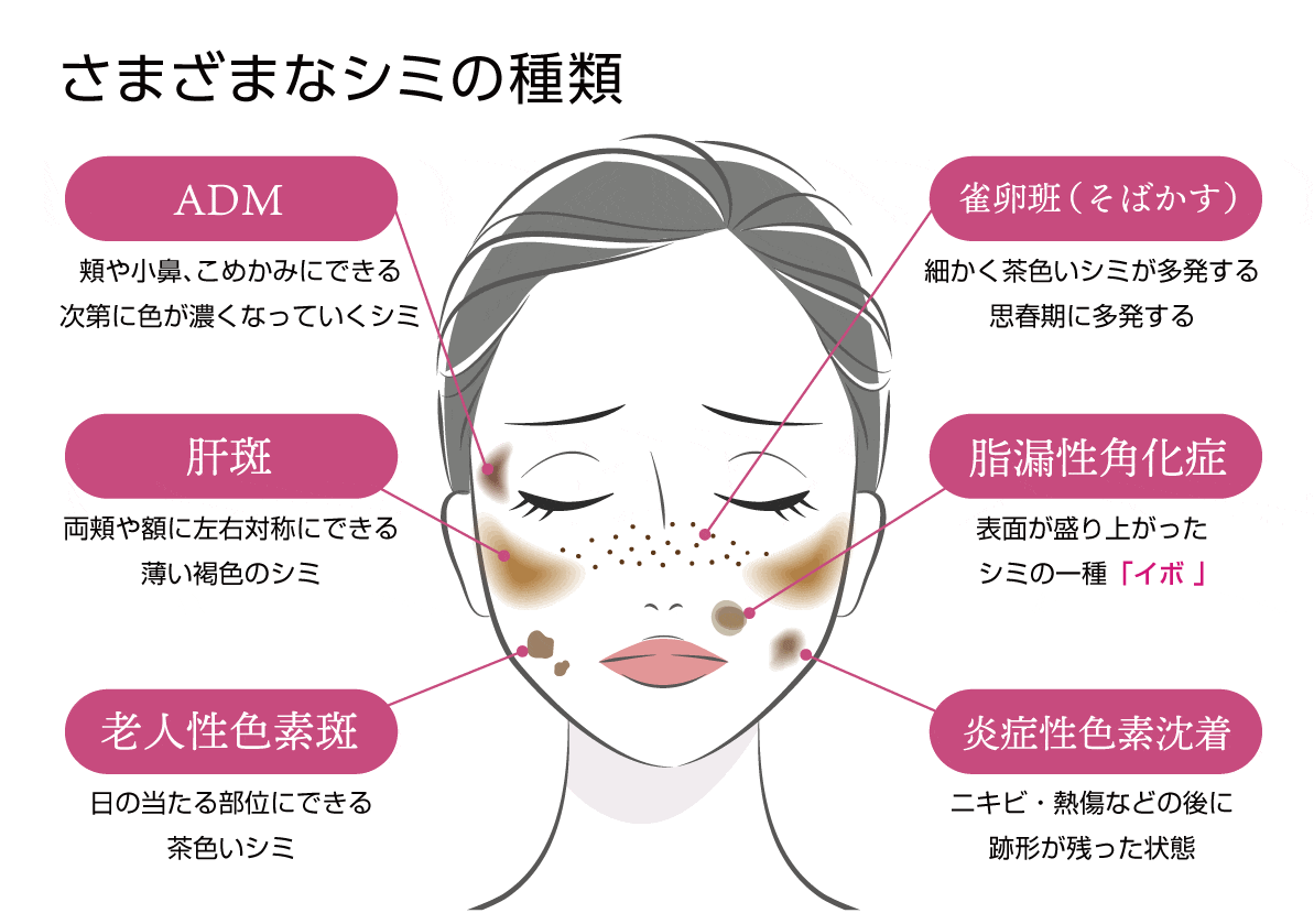 シミの種類