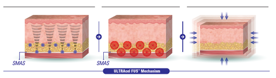 ULTRAcel Q＋