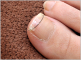Ingrown nail treatments