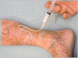Varicose veins in the Legs