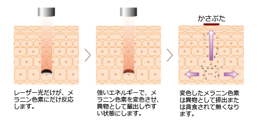 Qスイッチルビーレーザー