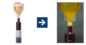 PRP (platelet rich plasma) therapy