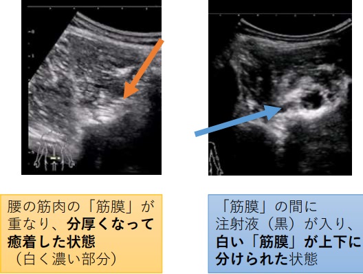 筋膜リリース画像